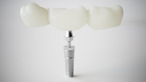 shrewsbury dental implants