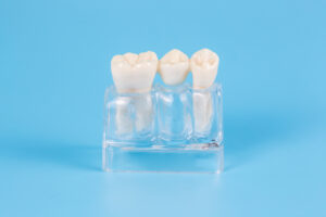 shrewsbury dental bridge