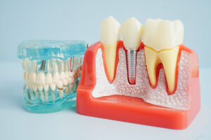 shrewsbury dental implants