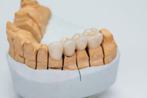 shrewsbury dental bridges
