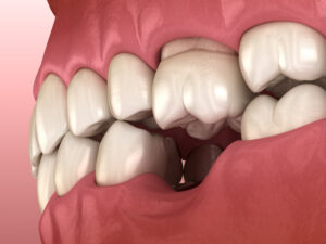 shrewsbury tooth loss