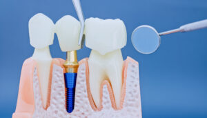 shrewsbury maxillofacial prosthetic